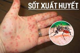 Các biện pháp phòng chống bệnh sốt xuất huyết
